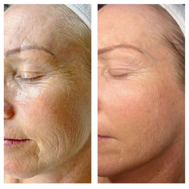 Face microneedling + RED Carpet at Freshly Plum Skincare in Sugar Hill, GA